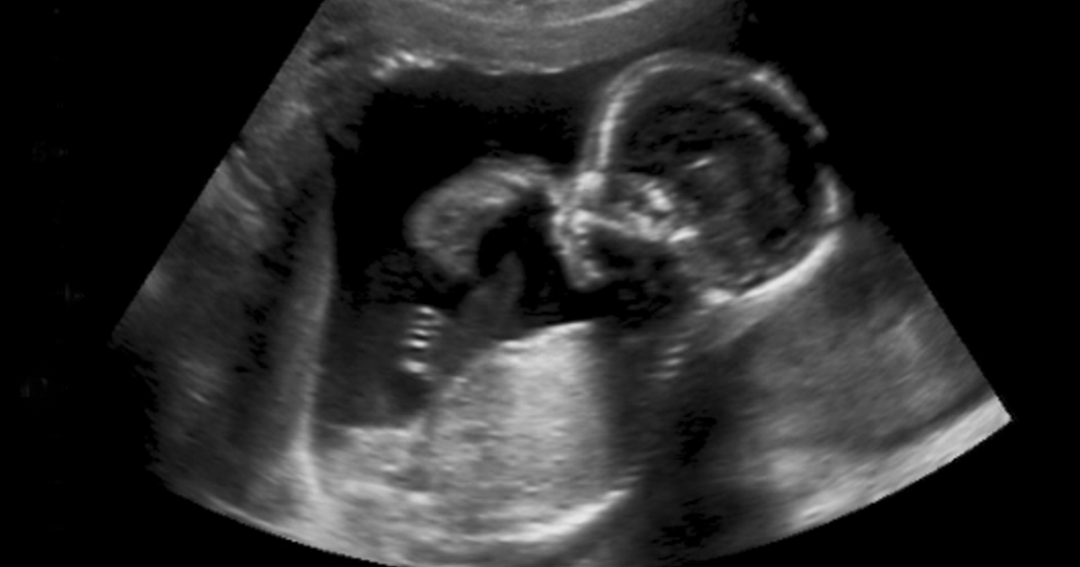 March 25 - Day of the Unborn Child